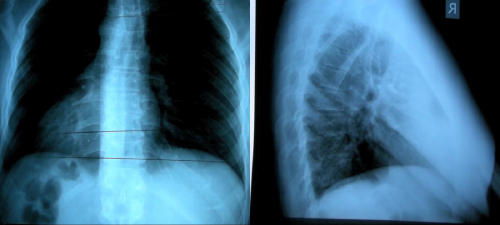 X-Ray Analysis